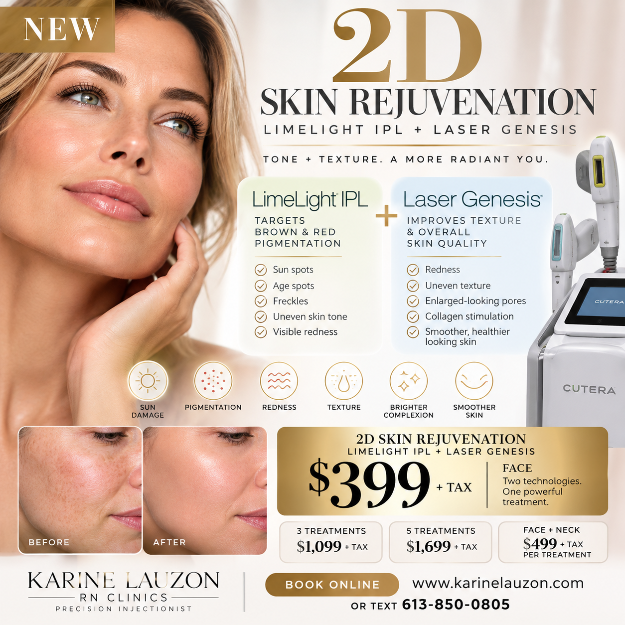 2D Power Combo — LimeLight IPL + Laser Genesis · $399 · Karine Lauzon RN Clinics