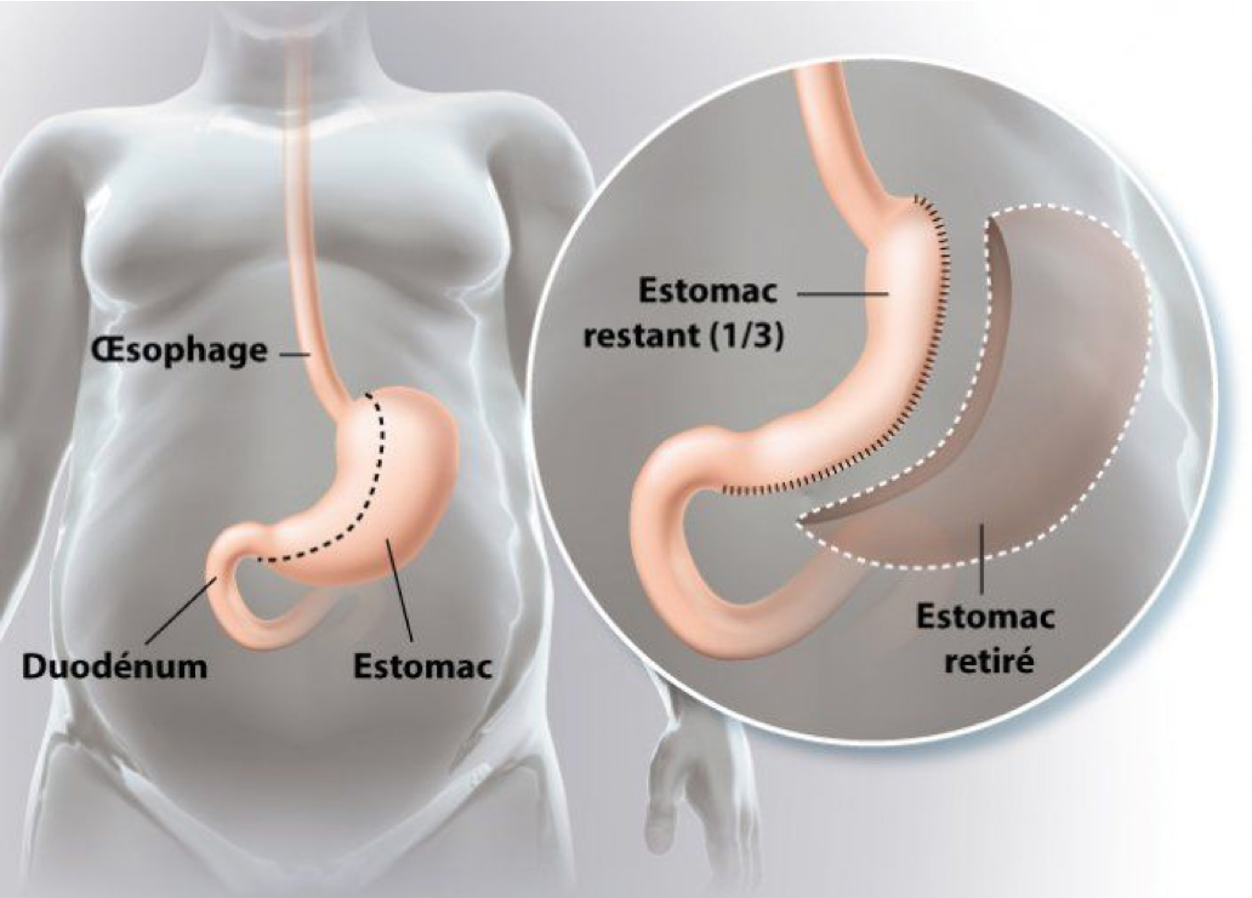 Illustration de la technique : Sleeve gastrectomie